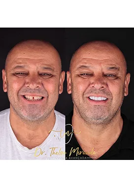 antes-depois-14