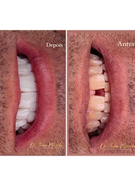 antes-depois-15