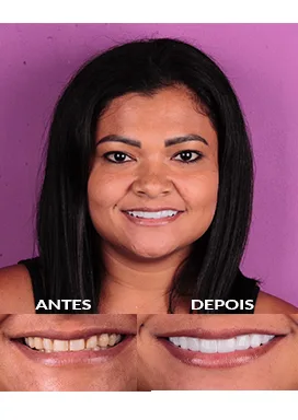 antes-depois-20